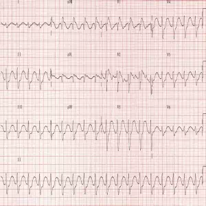 TCA Toxicity 01 Terminal R Wave in aVR